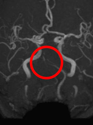 椎⾻・脳底動脈還流不全（VBI：VertebrobasilarInsufficiency）