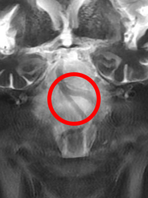 椎⾻・脳底動脈還流不全（VBI：VertebrobasilarInsufficiency）