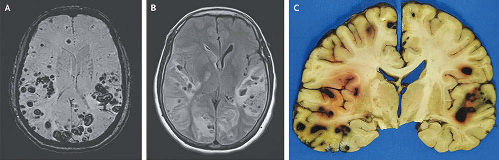 レカネマブ投与後における脳梗塞、t-PA投与にて多発性脳出血