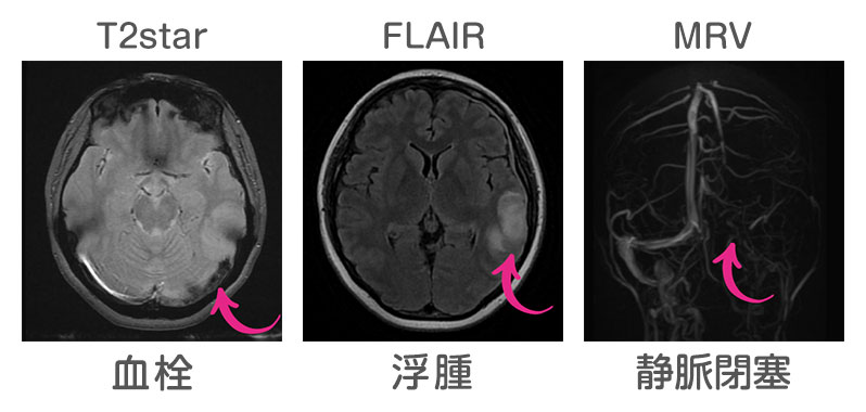 脳静脈洞血栓症 T2star（血栓） FLAIR（浮腫） MRV（静脈閉塞）
