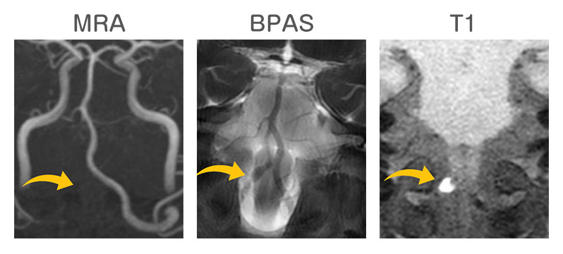 椎骨動脈解離（MRA BPAS T1）