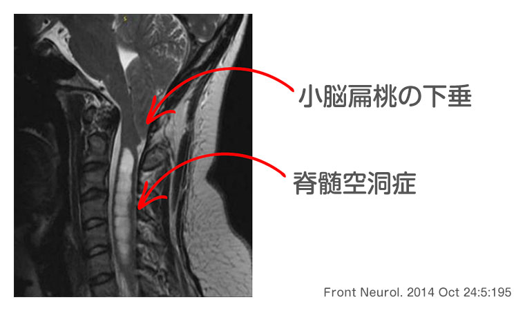 キアリ奇形 小脳扁桃の下垂 脊髄空洞症
