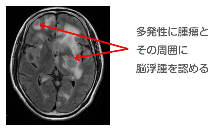 転移性脳腫瘍 多発性に腫瘤とその周囲に脳浮腫を認める