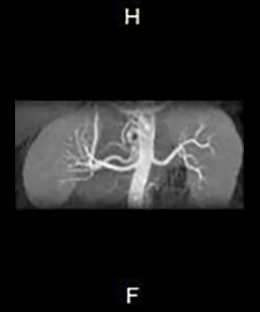 MRI参考画像 腎動脈