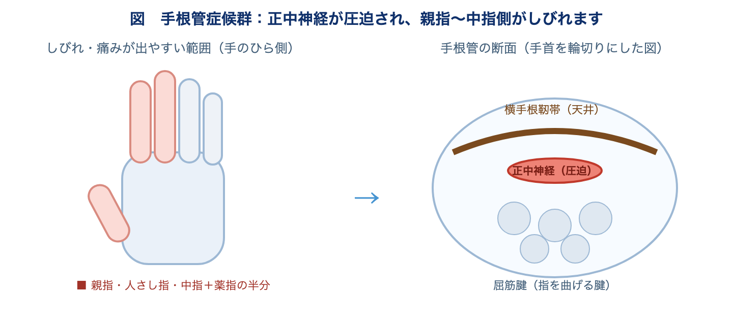 手根管症候群の図。手首の手根管で正中神経が圧迫され、親指から中指側にしびれや痛みが出る