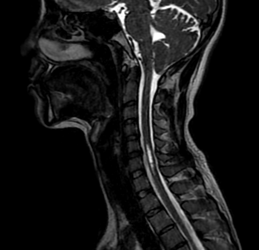 当院で撮影したキアリ奇形の矢状断MRI。小脳扁桃が脊柱管側へ下垂し、頸髄内に脊髄空洞症を合併している所見
