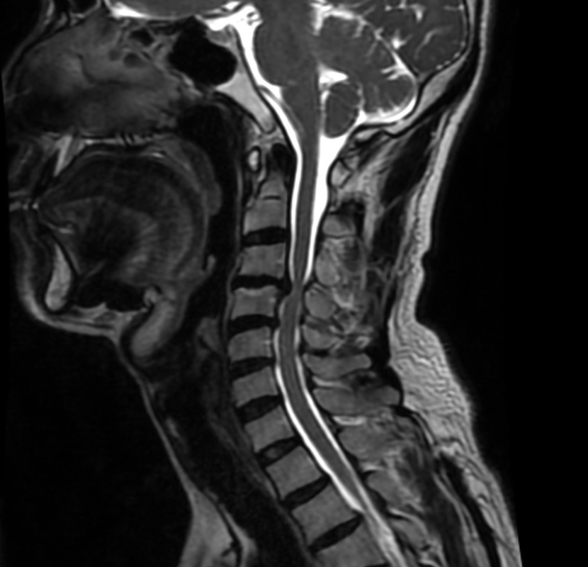 当院で撮影した頚椎症の矢状断MRI。椎間板の変性・脊柱管の狭窄・脊髄の圧迫を評価できます