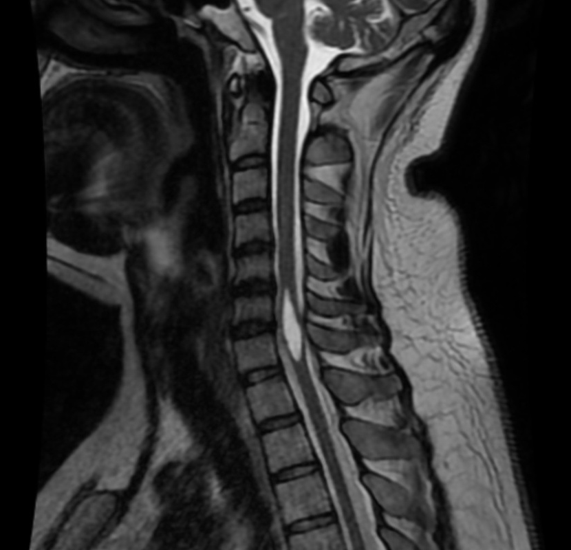 当院で撮影した脊髄空洞症の矢状断MRI。脊髄の内部に液体のたまった空洞（シリンクス）がみられる所見