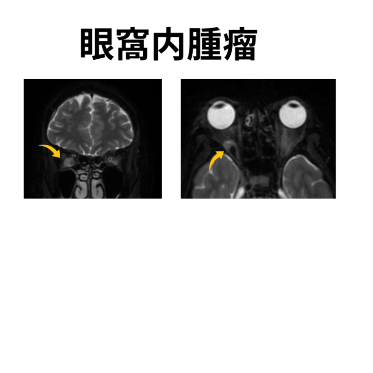 知らないとヤバい目の奥が痛い頭痛の理由【頭痛専門医の見解】 | 頭痛・めまい・物忘れ・即日MRI|大阪市城東区 いわた脳神経外科