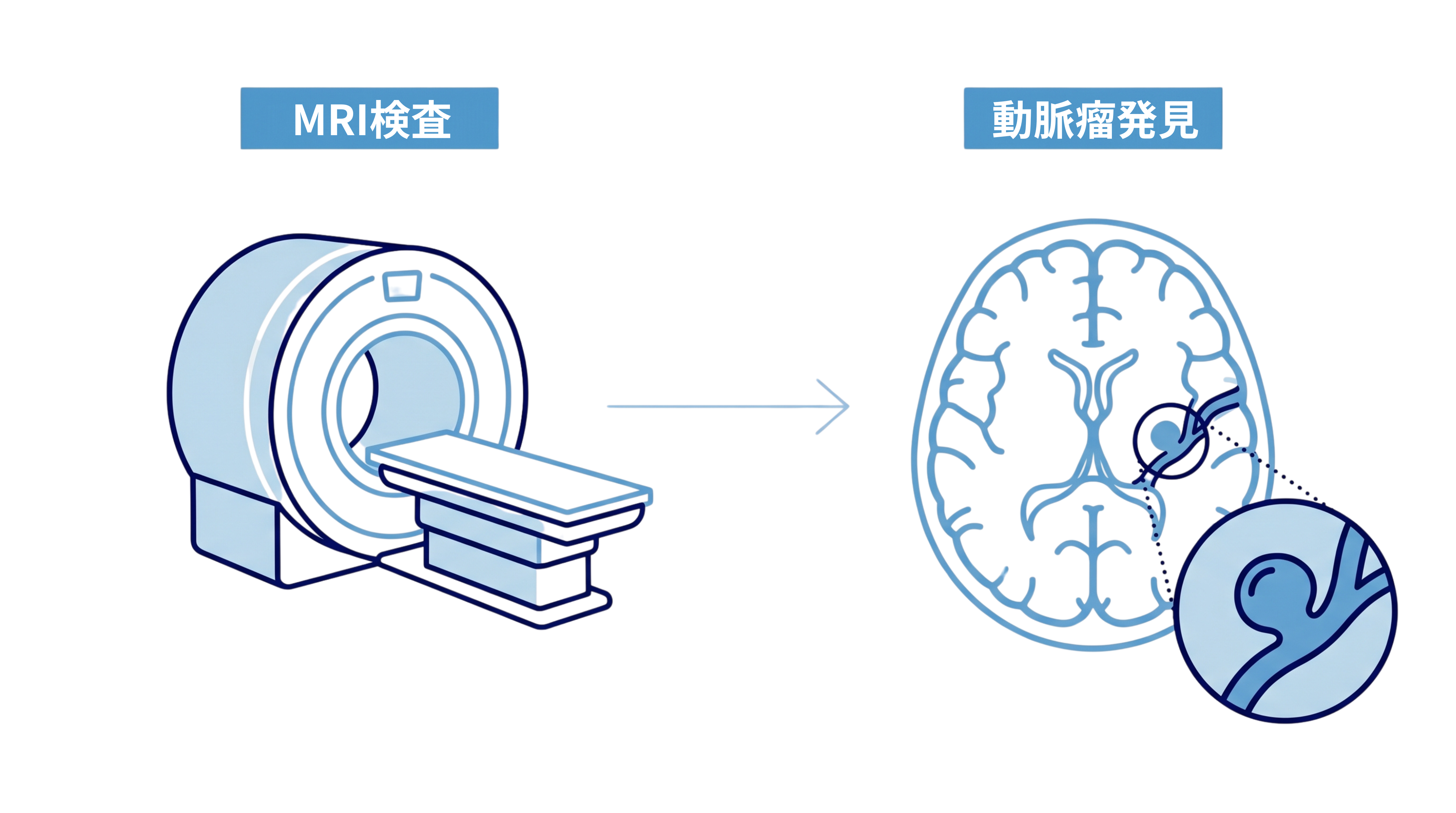 MRI検査で脳の血管と未破裂脳動脈瘤を見つけるイラスト