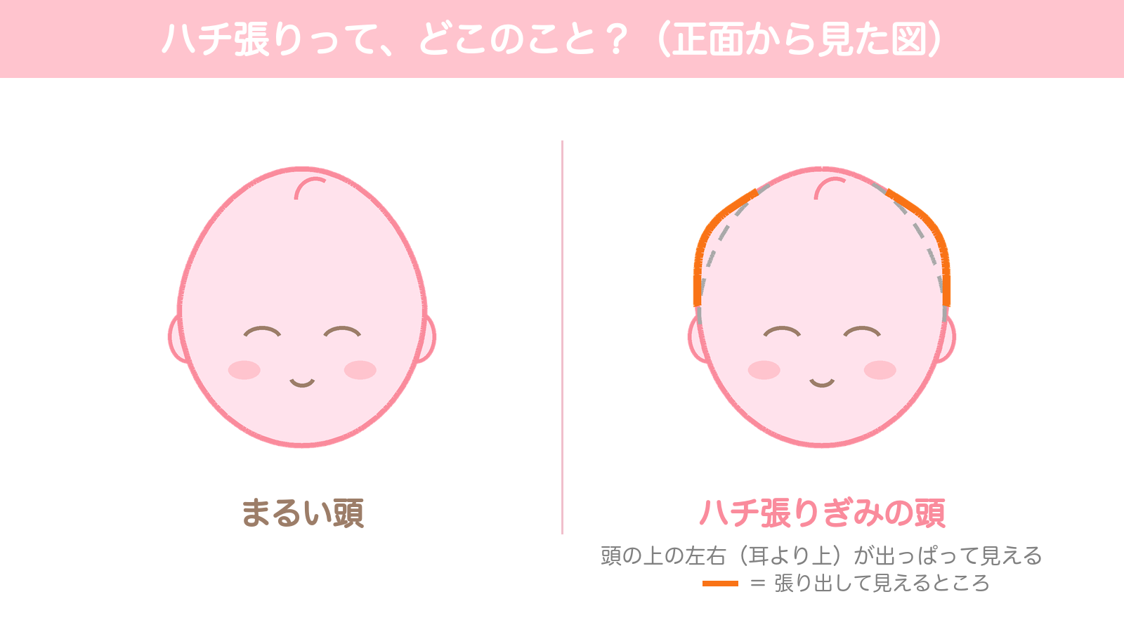 まるい頭とハチ張りぎみの頭を正面から比べた図。ハチ張りぎみの頭は、耳より上の左右が出っぱって見える部分をオレンジで示している